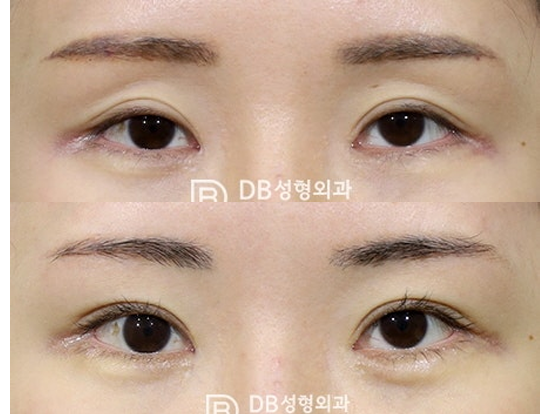 눈위꺼짐 심한 꺼진눈, 아이홀 개선 위한 눈위지방이식 안내