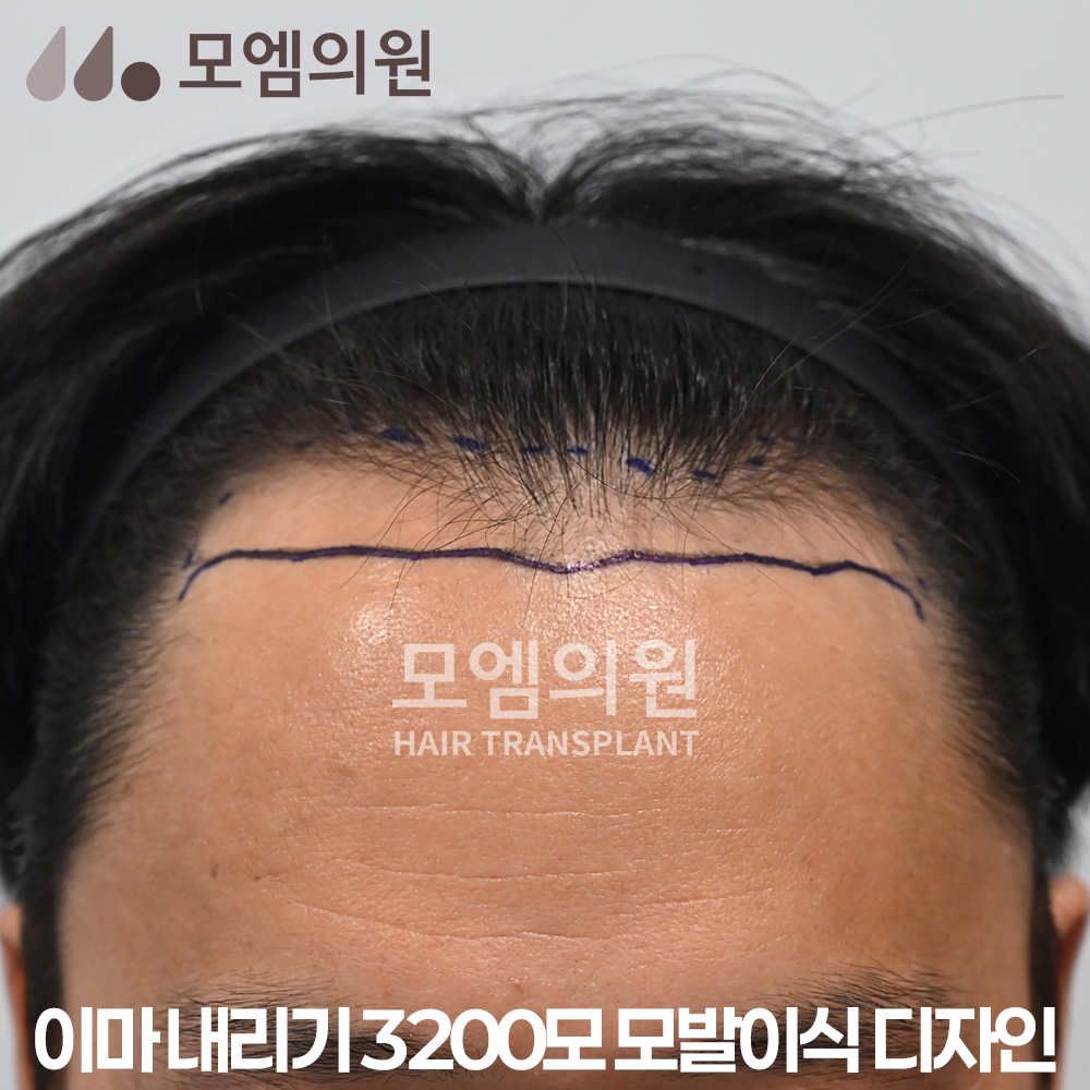 30대 탈모, 헤어라인 모발이식으로 높은 이마 내리기