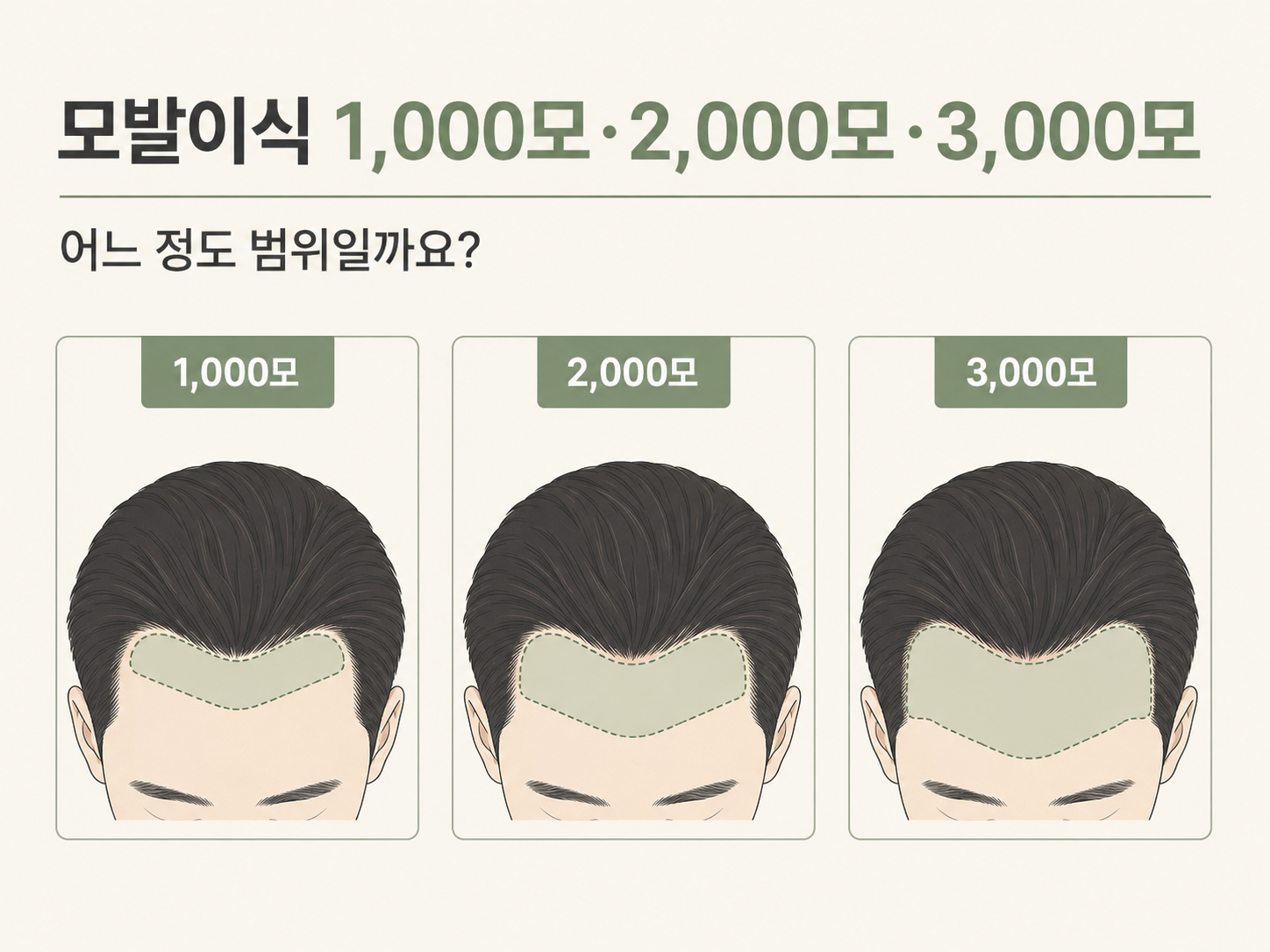 모발이식 1000모·2000모·3000모, 어느 정도 범위일까?