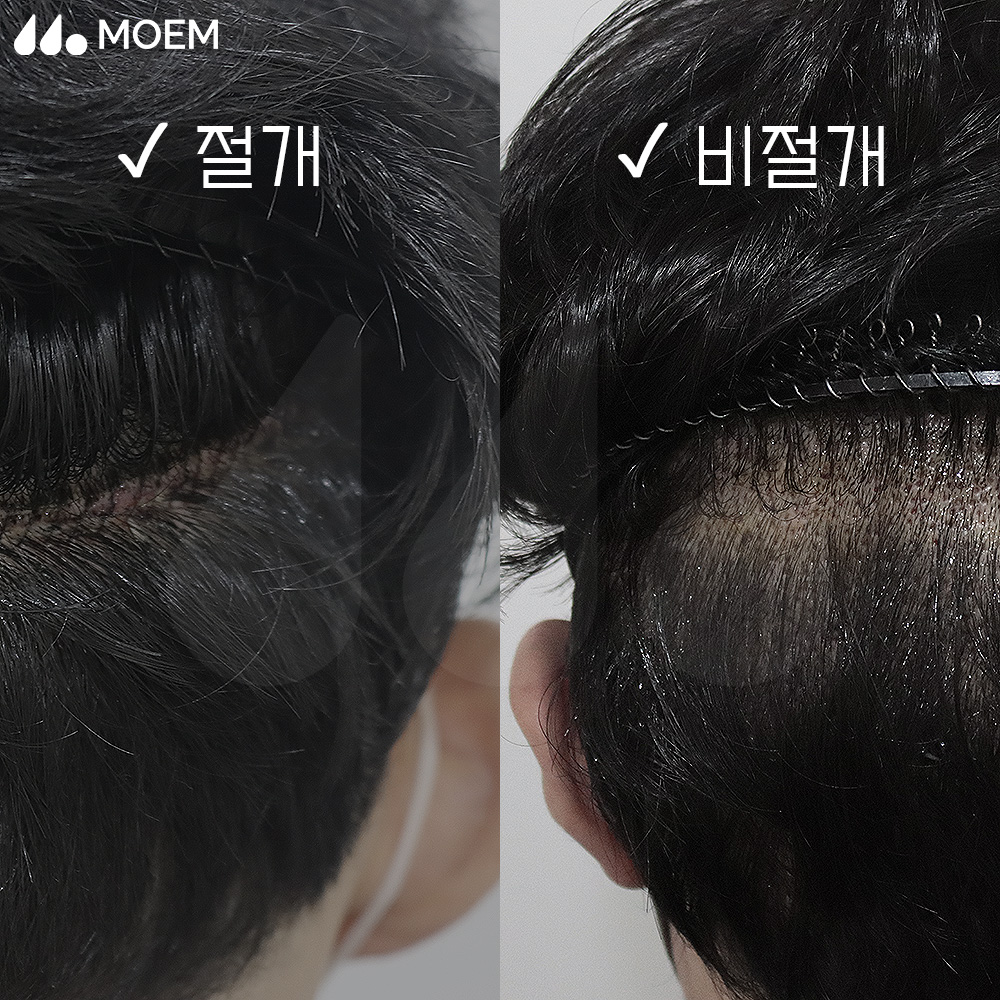 모발이식 수술 종류 총정리: 절개·비절개·히든컷 비교