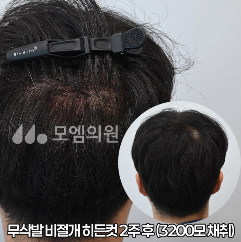 비절개모발이식 박스컷·투블럭·히든컷 차이 완전 비교