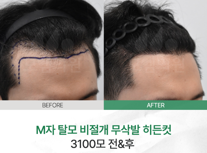 인플루언서·연예인이 히든컷 모발이식을 선택하는 이유