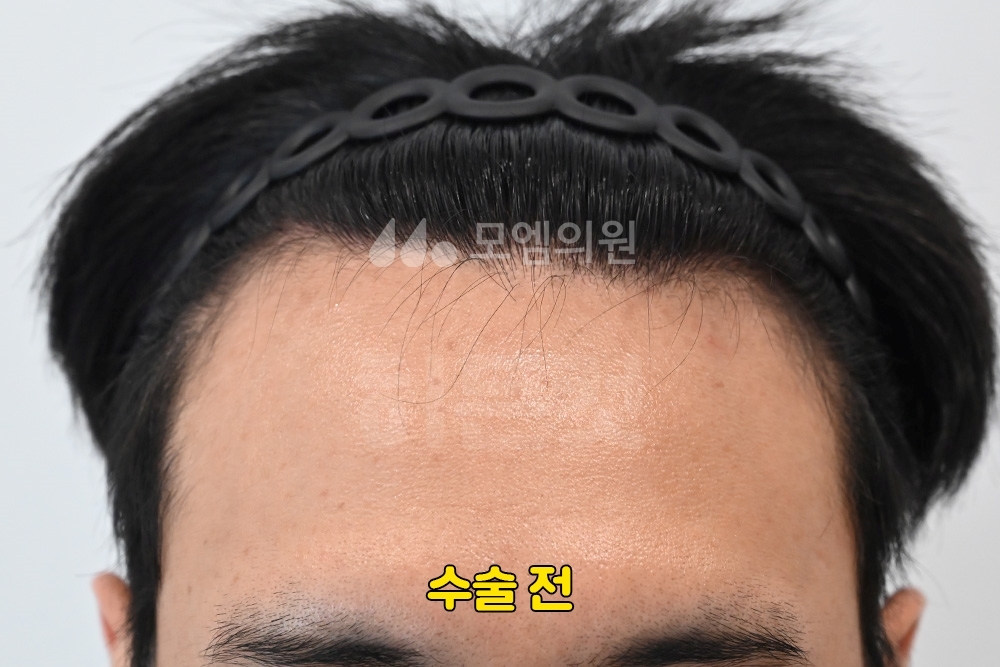 히든컷 모발이식, 일반 FUE와 어떤 차이가 있을까