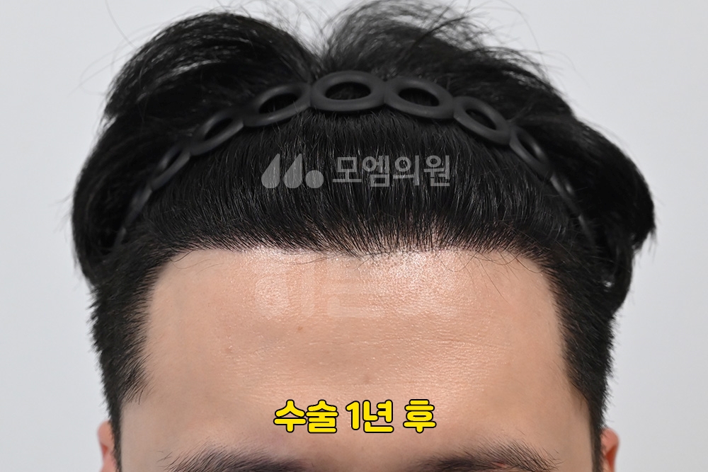 히든컷 모발이식, 티 안 나는 비절개 수술의 원리