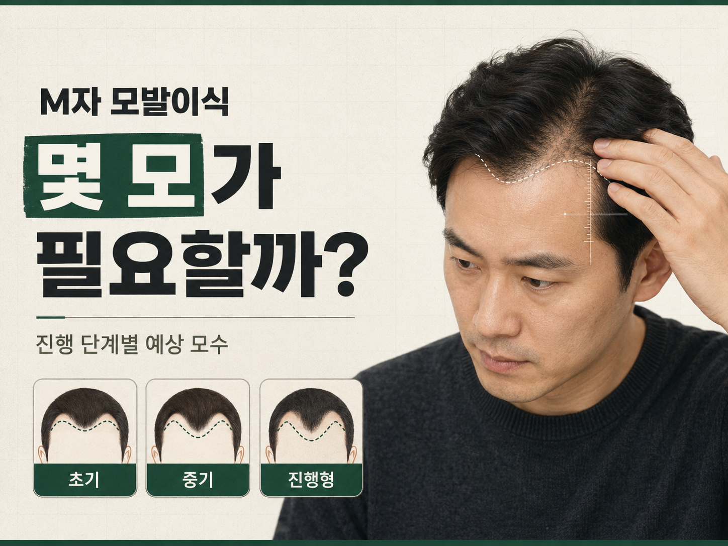 M자 모발이식 필요 모수, 진행 단계별로 얼마나 될까