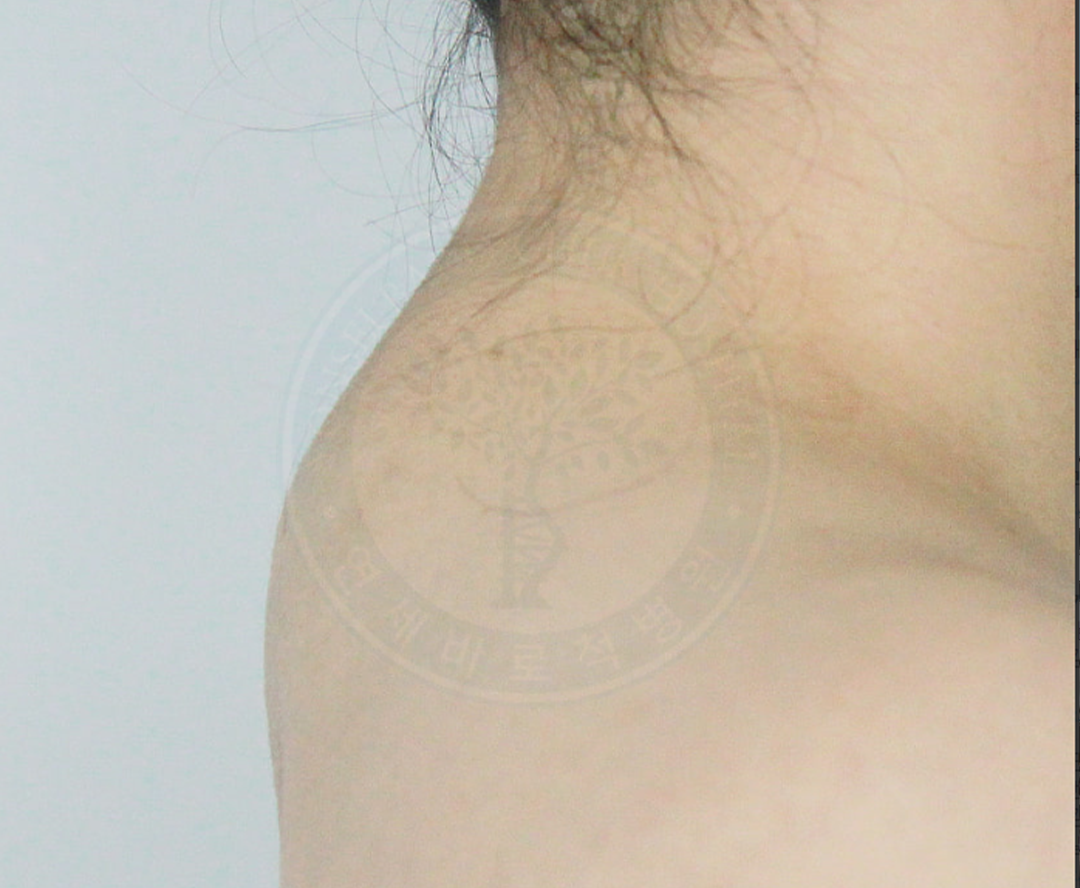 버팔로험프(Buffalo Hump) 증상과 치료, 지방흡입·운동으로 안되는 이유